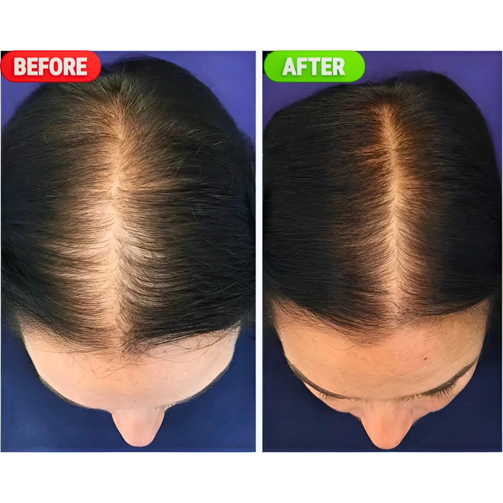 Minoxidil 5% Hair Regrowth Spray for Men & Women