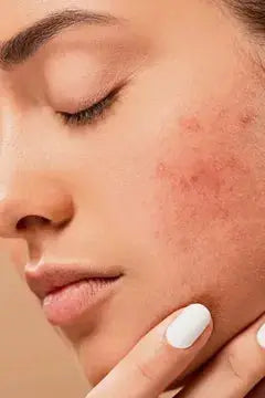 Acne & Breakouts Beausial