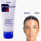 Acne Clear Face Wash Facial Foam 85 ml