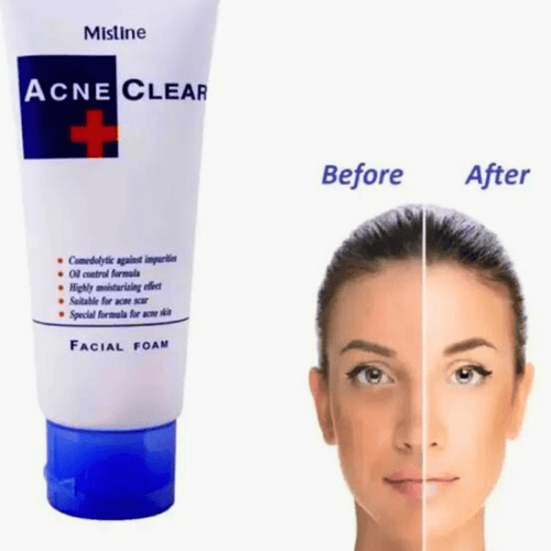 Acne Clear Face Wash Facial Foam 85 ml
