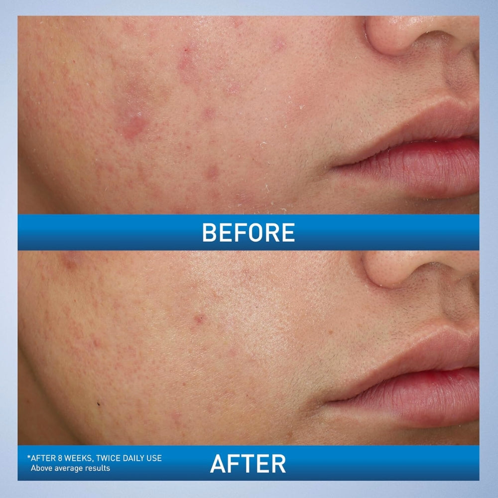 CeraVe Acne Foaming Cream Cleanser 4% BPO 150ml