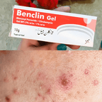 Benclin Acne Gel – Scar & Blackhead Removal Cream