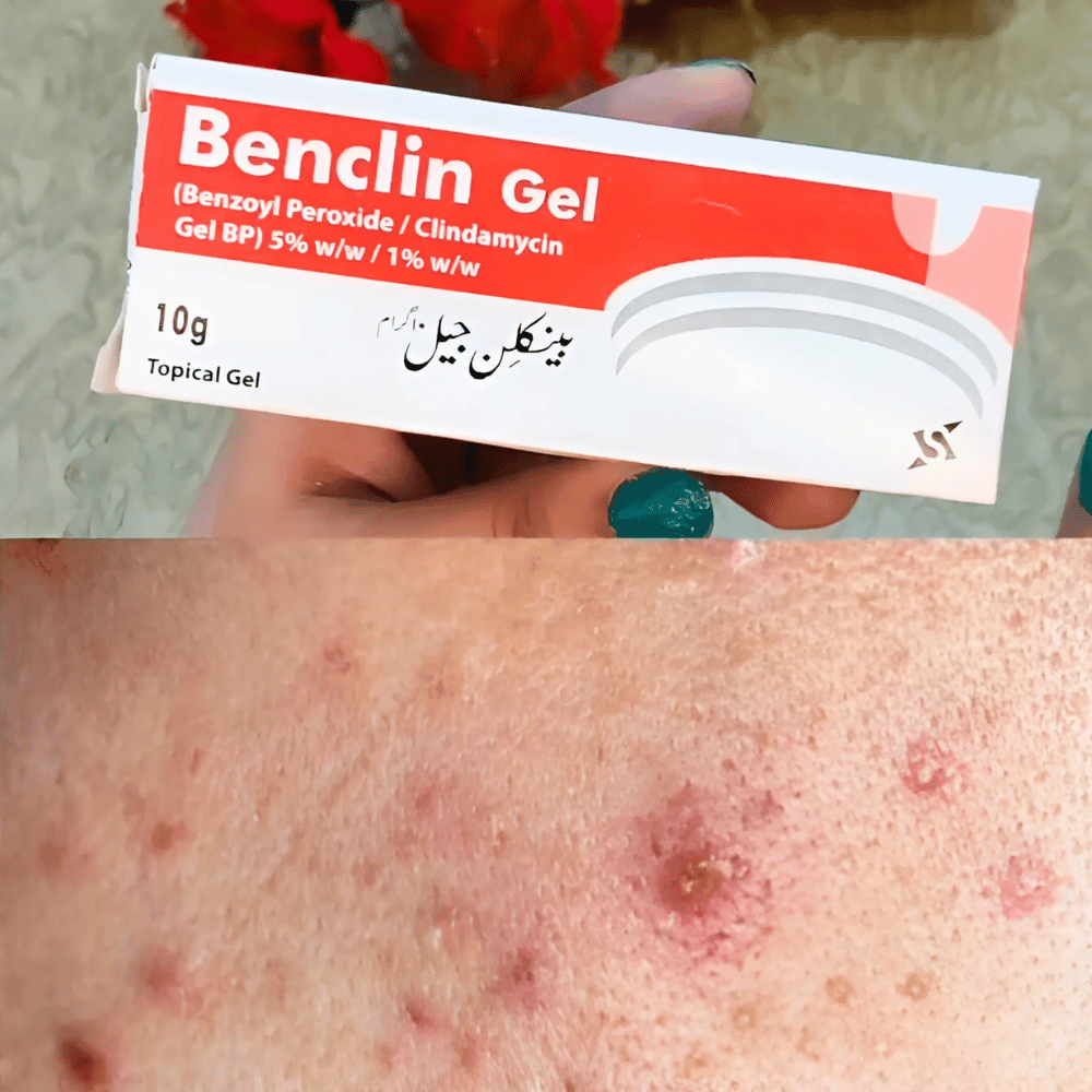 Benclin Acne Gel – Scar & Blackhead Removal Cream