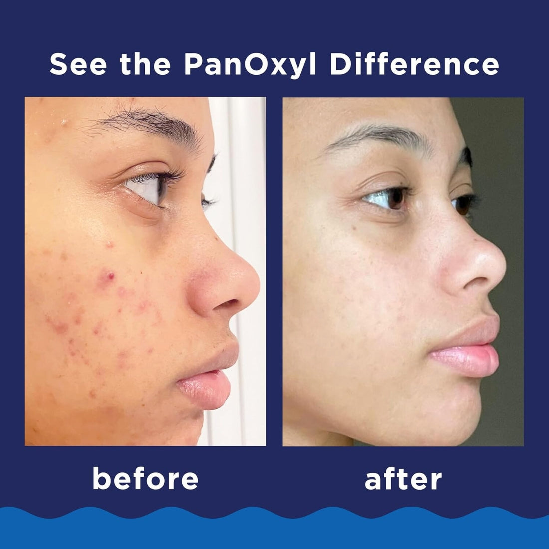 PanOxyl Acne Foaming Wash 10% Maximum Strength 156ml