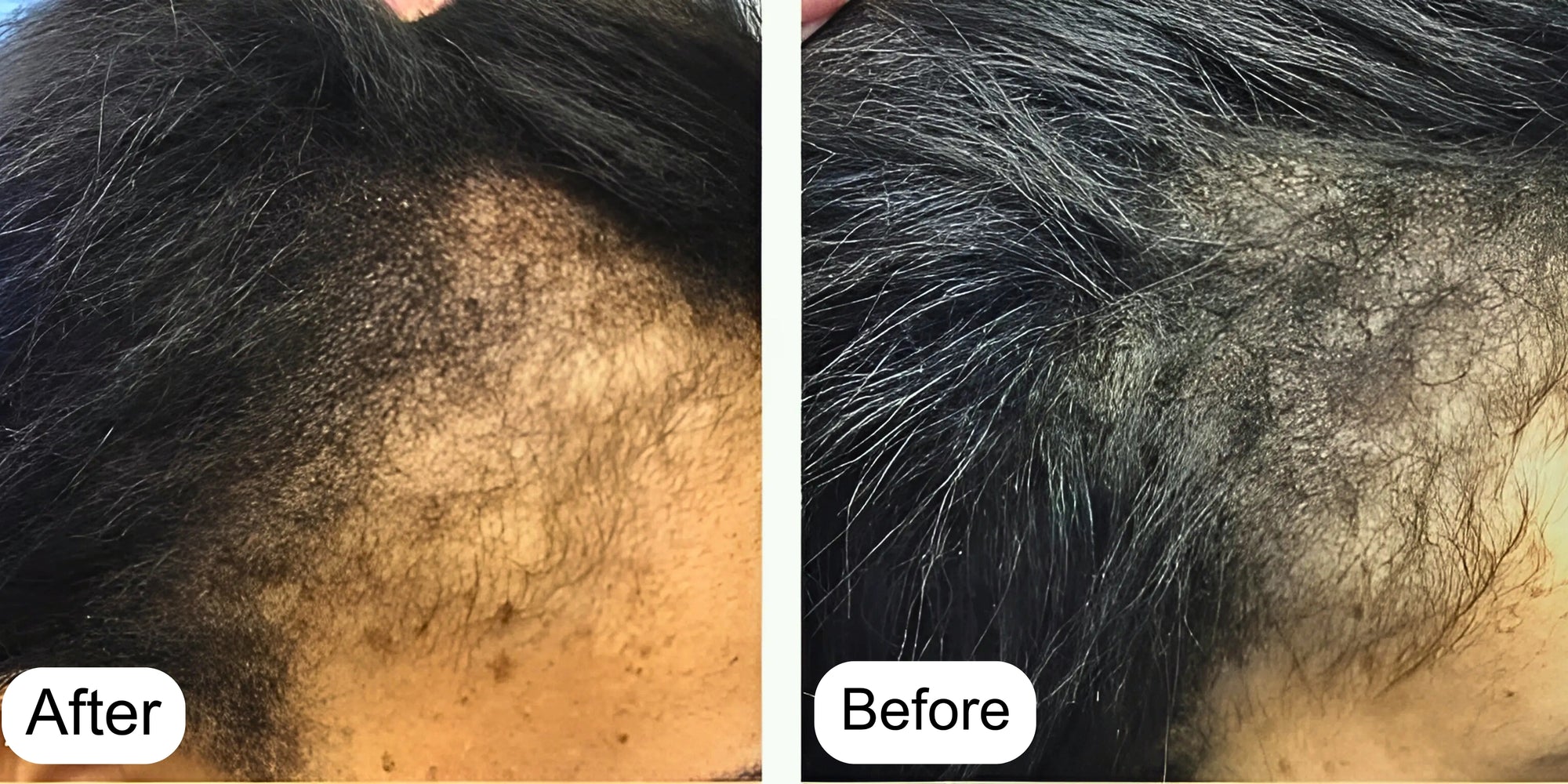 Minoxin 5% Minoxidil Hair Regrowth Spray 60ml