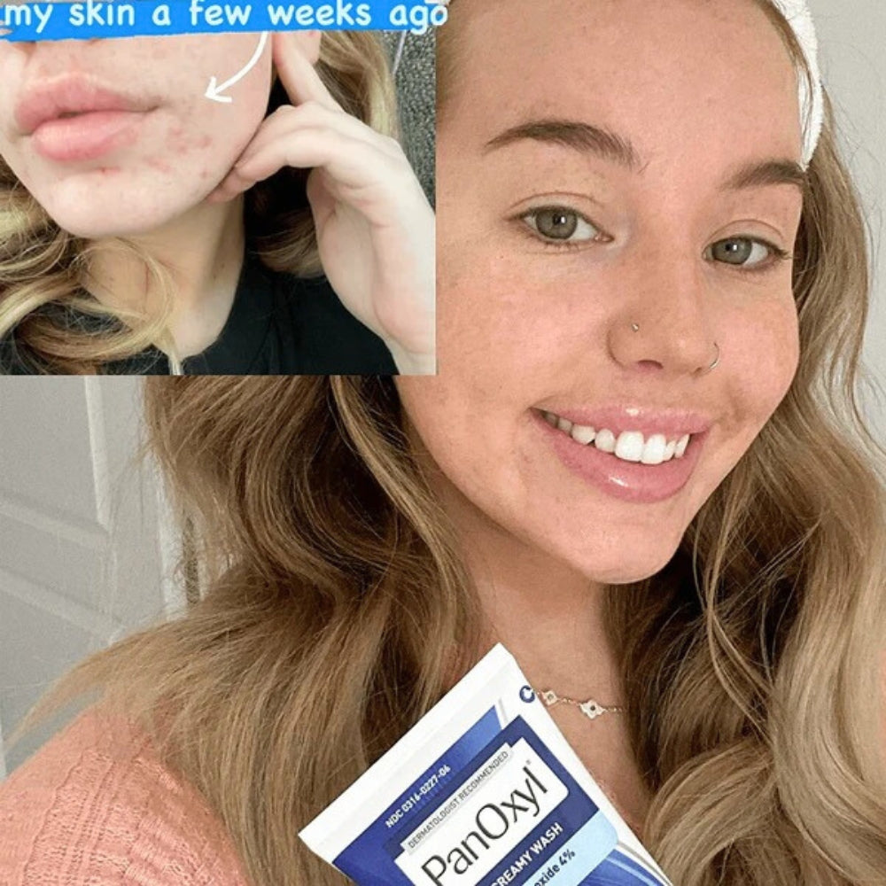 PanOxyl Acne Creamy Wash 4% Daily Control 170g