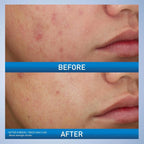 CeraVe Acne Foaming Cream Cleanser 4% BPO 150ml