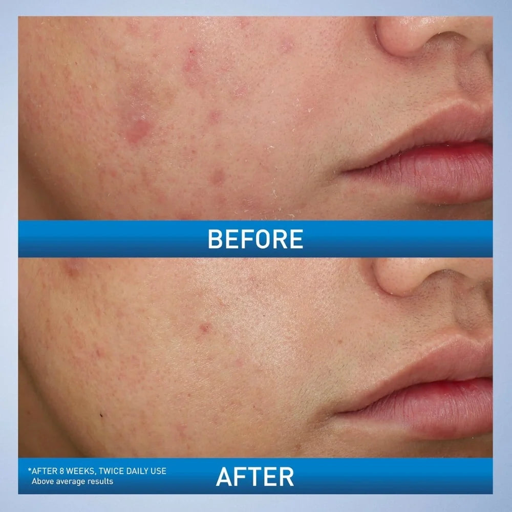 CeraVe Acne Foaming Cream Cleanser 4% BPO 150ml CeraVe