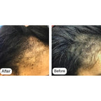 Before and after hair thinning comparison with Minoxin 5% Minoxidil spray
