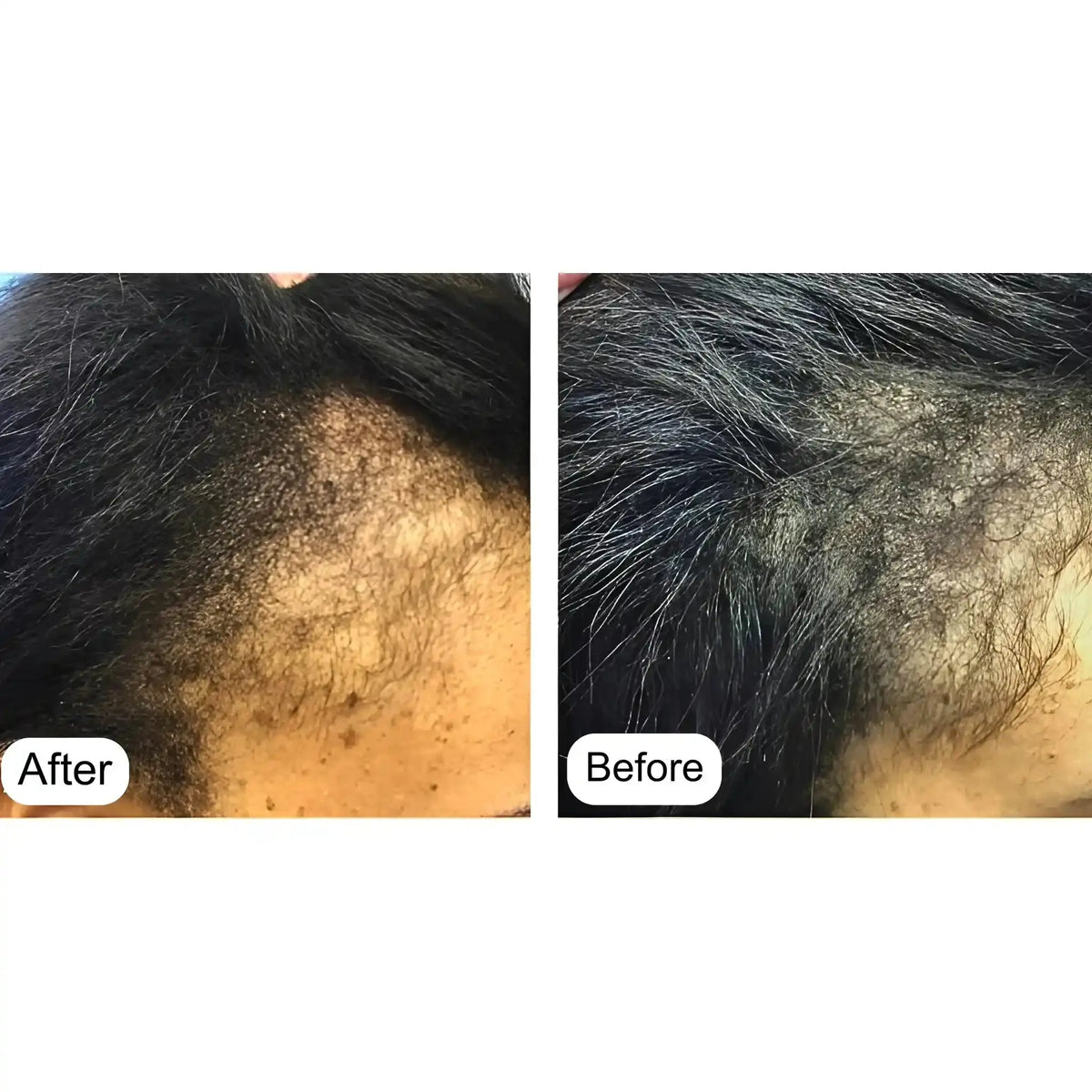 Before and after hair thinning comparison with Minoxin 5% Minoxidil spray