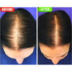 Hair regrowth progress before and after using Minoxin 5% hair spray
