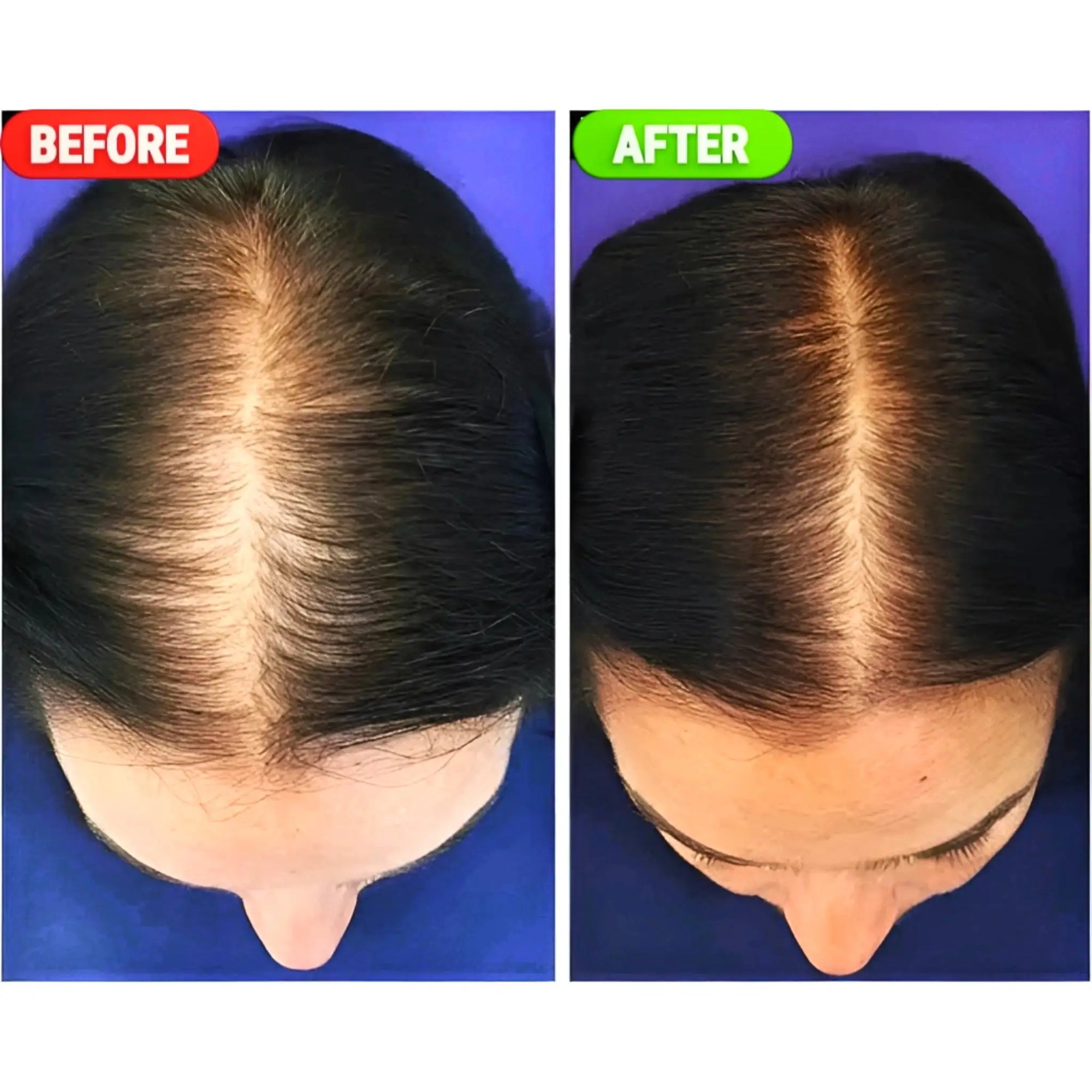 Hair regrowth progress before and after using Minoxin 5% hair spray