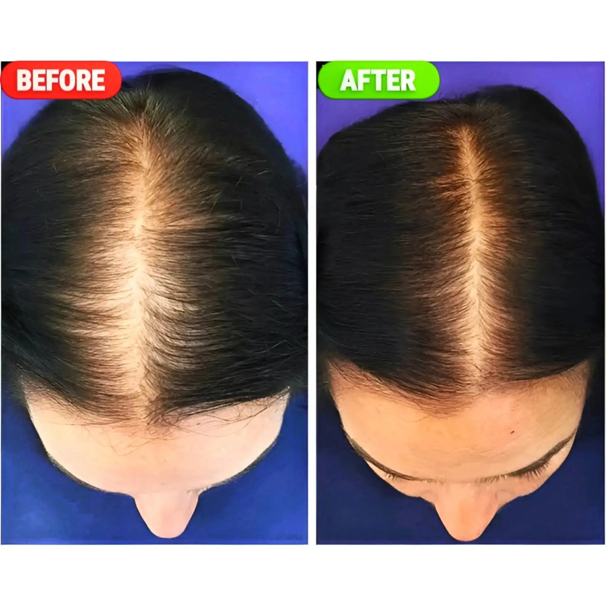 Hair regrowth progress before and after using Minoxin 5% hair spray